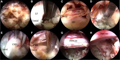 Fully endoscopic transforaminal discectomy for thoracolumbar junction disc herniation with or without calcification under general anesthesia: Technical notes and preliminary outcomes